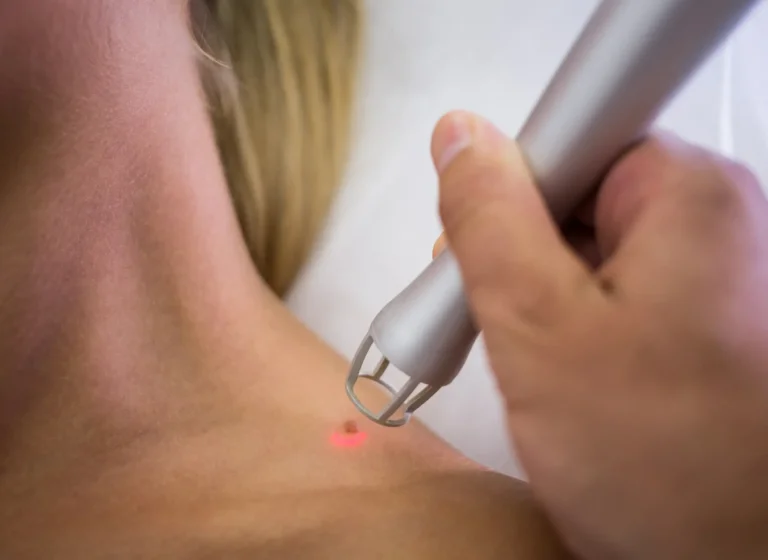 billede viser en patient der får laser behandling på sin skulder